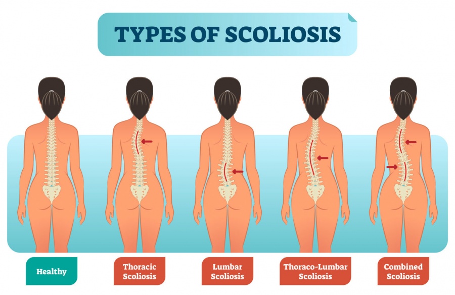 scoliosis_types
